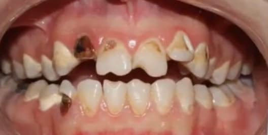 الحشو التجميلي before 