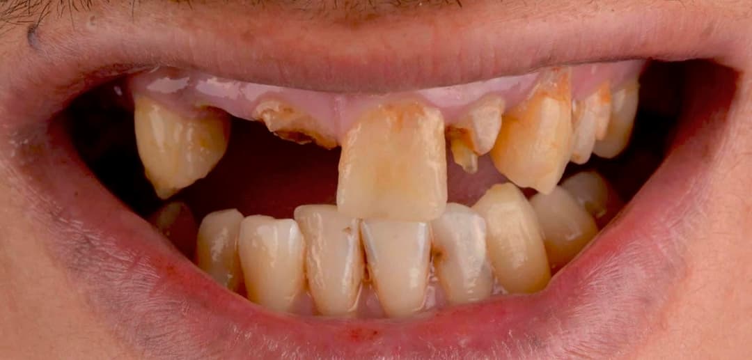 تركيبات ثابته before 
